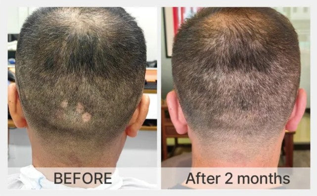 Significant regrowth seen in uneven areas