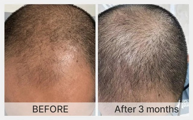 Fuller hair on the crown